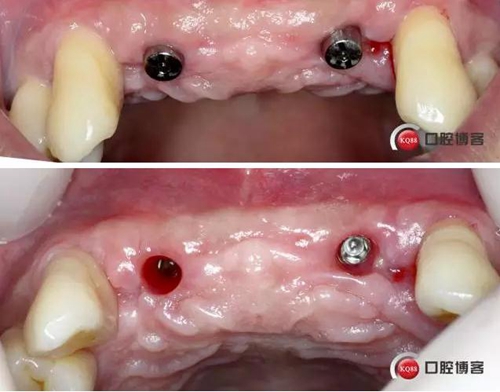 一例前牙重度牙周病8个月的种植漫长修复