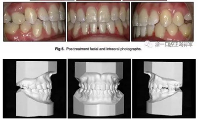 文献优秀正畸病例赏析--非手术治疗Ⅲ类错颌畸形伴后牙开合 科贸嘉友