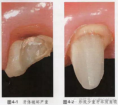 中的第一步,应该是按照最终冠修复体的牙体预备要求进行牙体初步预备