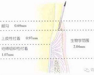 所以这里我只讲龈下肩台凳滓 嘉友资讯中心 材料应用 牙体制备时肩台