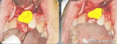种植牙植骨的步骤一般是什么呢？