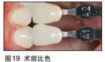 利用支抗钉压低对颌过长牙后种植修复