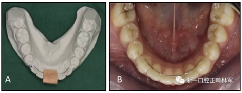 正畸文献阅读--两种舌侧保持器弓丝在下颌牙弓保持中的临床效果比较