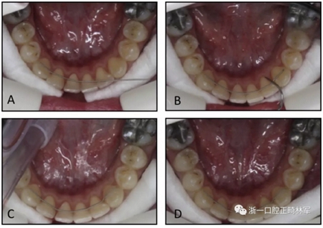 正畸文献阅读--两种舌侧保持器弓丝在下颌牙弓保持中的临床效果比较
