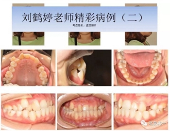 多学科病例分析---正畸、种植、微创拔牙多学科交叉病例