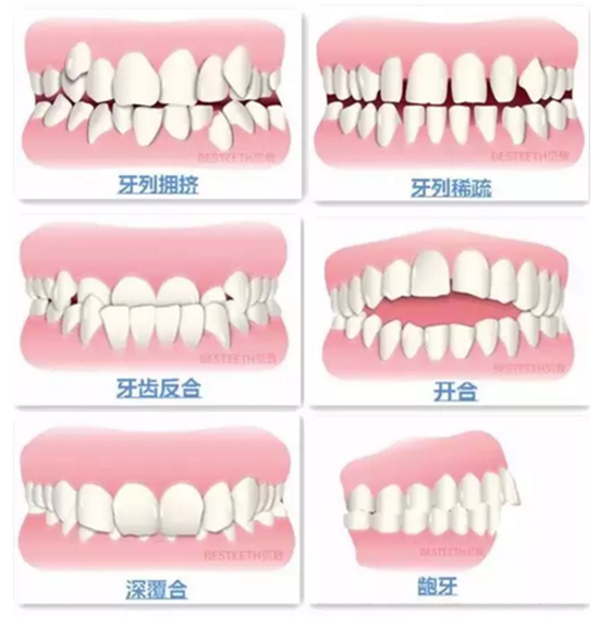 【口腔科普】关于矫牙前、中、后需要注意的问题，了解一下？