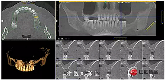 常规拔除患牙,清创,冲洗,先锋钻定位,逐级扩孔,在25,26位置行上颌窦