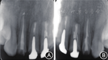 【病例讨论】根管治疗失败患牙再治疗一例（下）