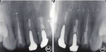 【病例讨论】根管治疗失败患牙再治疗一例（下）