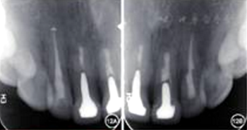 【病例讨论】根管治疗失败患牙再治疗一例（下）