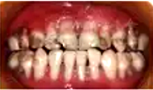 重型先天性中性粒细胞缺乏症伴牙周损害