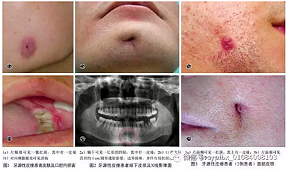 【临床研究】牙源性皮瘘9例临床分析