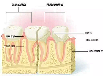 牙周病发展过程