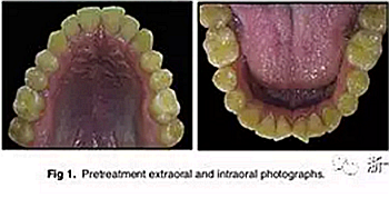 文献优秀正畸病例赏析-通过微种植钉及多曲方丝技术压低下颌磨牙非手术矫治严重前牙开合患者1例