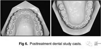 文献优秀正畸病例赏析-通过微种植钉及多曲方丝技术压低下颌磨牙非手术矫治严重前牙开合患者1例