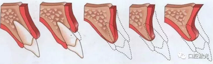 激光辅助牙槽嵴保存技术