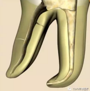知识分享：根管治疗的标准步骤