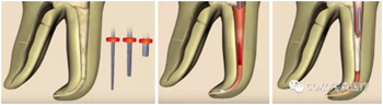 知识分享：根管治疗的标准步骤