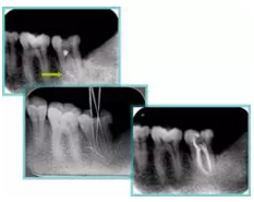 知识分享：根管治疗的标准步骤