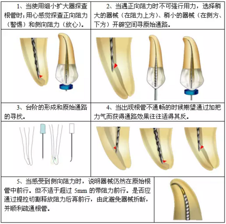 知识分享：根管治疗的标准步骤