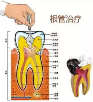 医生，牙齿折断不是应该补上去吗，为啥要做根管治疗？