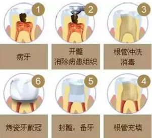 医生，牙齿折断不是应该补上去吗，为啥要做根管治疗？