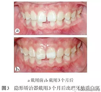 专题笔谈 | 无托槽隐形矫治技术