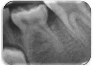 文献直达｜一项西班牙的研究：低位乳磨牙的发生频率、程度、牙根吸收和前磨牙发育不全情况