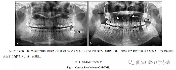 46例患者第三磨牙区多生牙的影像学分析