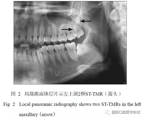 46例患者第三磨牙区多生牙的影像学分析