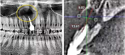 「科普篇」你真的了解它吗？——β-磷酸三钙