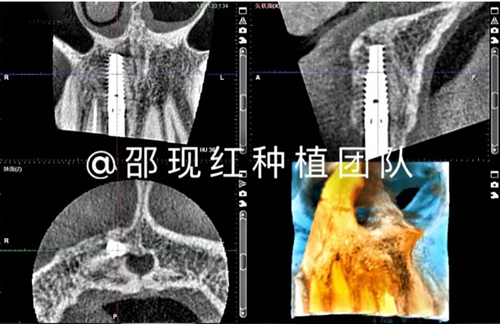 「科普篇」你真的了解它吗？——β-磷酸三钙