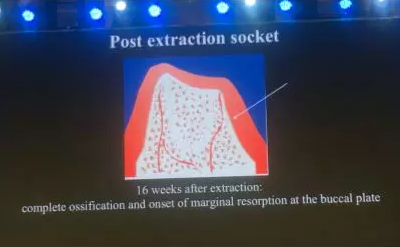 【听课笔记】拔牙后位点的软硬组织处理