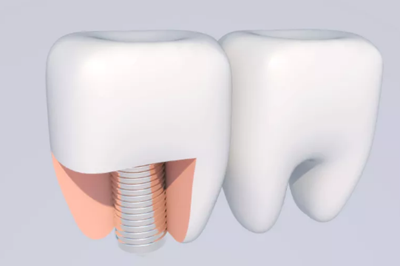 牙桩、牙冠、活动义齿修复材料，怎么选？