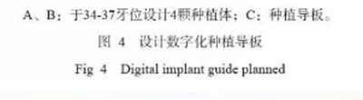 下颌骨腓骨移植联合牙种植术后的覆盖义齿修复1例