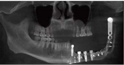 下颌骨腓骨移植联合牙种植术后的覆盖义齿修复1例
