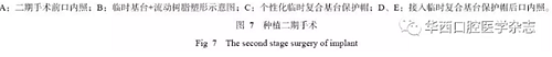 下颌骨腓骨移植联合牙种植术后的覆盖义齿修复1例