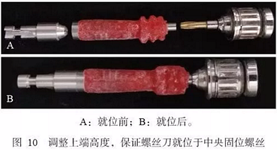 下颌骨腓骨移植联合牙种植术后的覆盖义齿修复1例