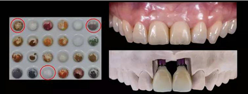 Asc全瓷角度基台一体冠进行种植前牙美学修复一例