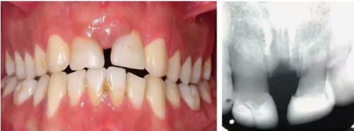 【病例分享】上颌中切牙区外伤的自体移植和正畸治疗