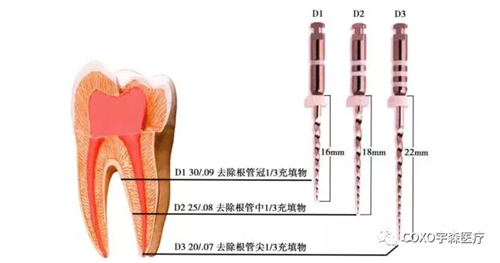 （十一期）根管充填物的清理-牙胶的去除