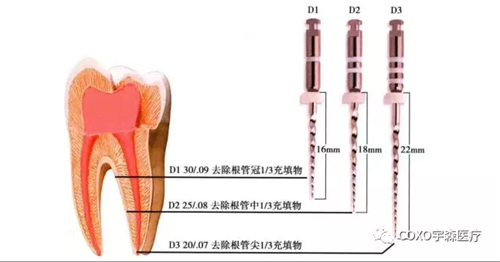 （十一期）根管充填物的清理-牙胶的去除