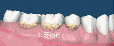 什么是牙龈萎缩？