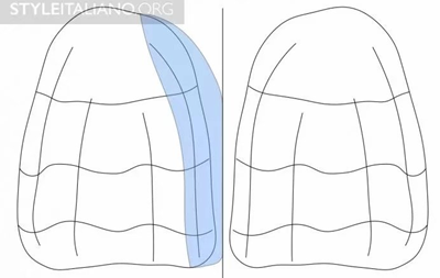 【分享】前翼技术关闭前牙间隙