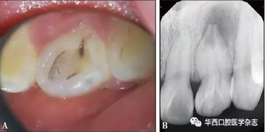根尖屏障技术治疗Ⅱ型牙内陷引发慢性根尖周炎1例