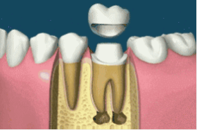 补牙不做冠，疗效少一半！根管治疗后牙齿已经不疼了，为什么还要戴牙冠呢？