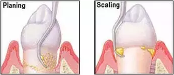 为什么洗牙后还要做牙周刮治？