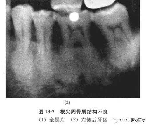 根尖周病与根尖周牙骨质结构不良