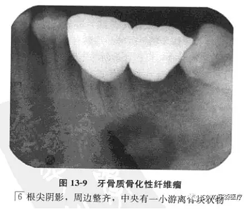 牙骨质骨化性纤维瘤
