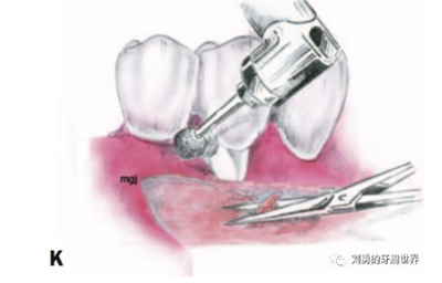 FGG游离牙龈移植在历史上的各种改良以及发展前景